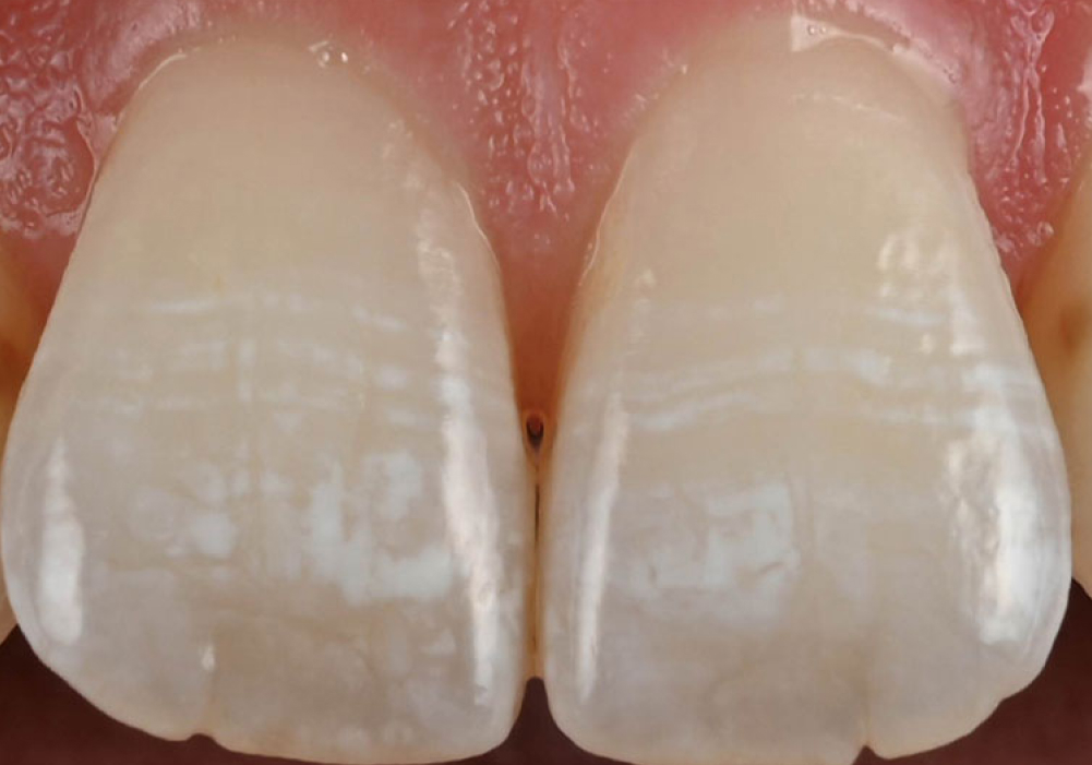 ホワイトスポットにも対応